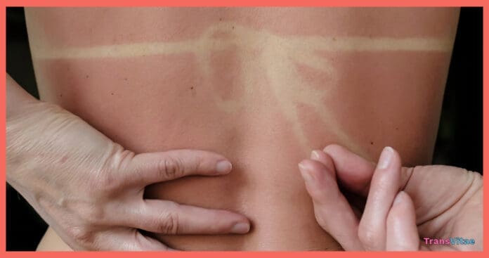 transgender sun protection