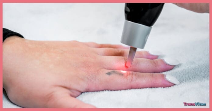 transgender tattoo removal hide